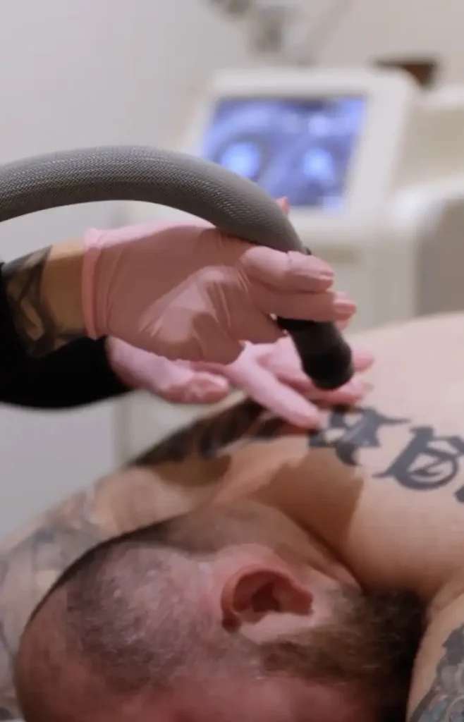 Close-up of tattoo removal treatment being performed on skin